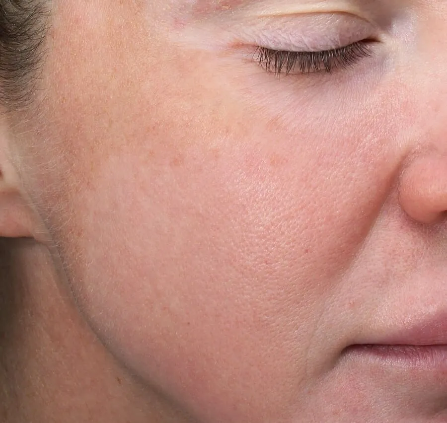 The same three-quarter view after Moxi, with the temple and upper cheek clear
