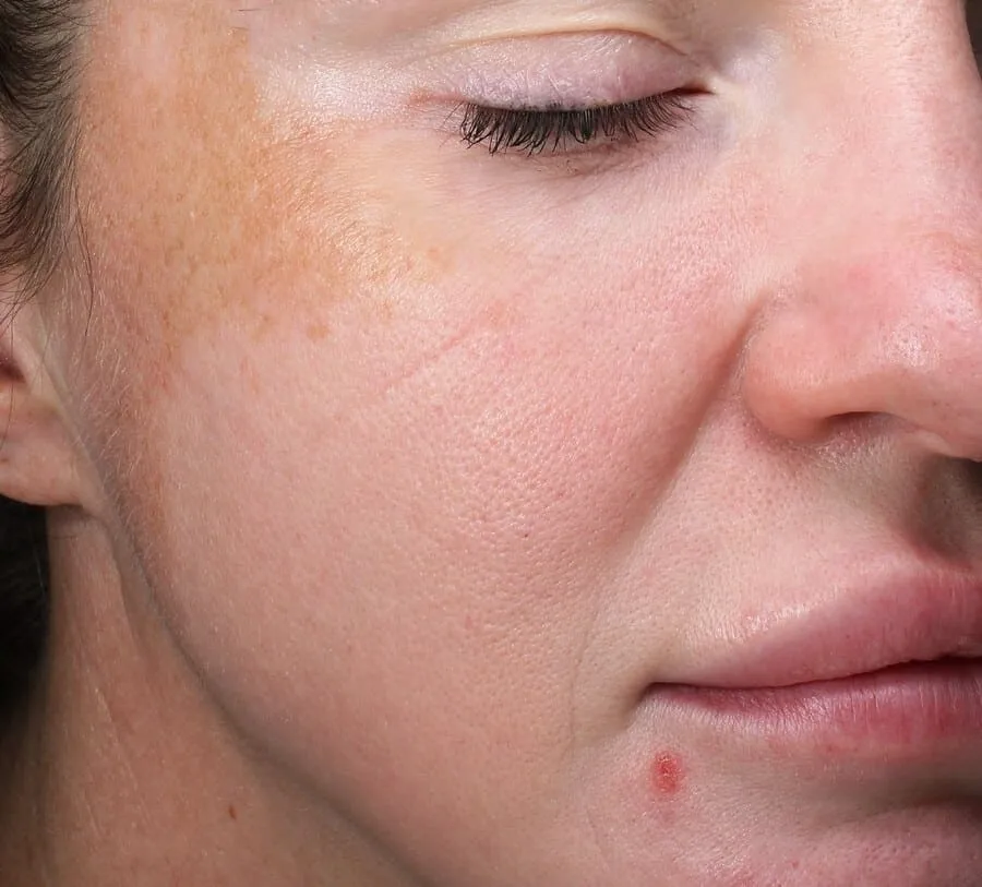 Three-quarter view of a woman before Moxi, showing a run of brown spots gathered at the temple and upper cheek