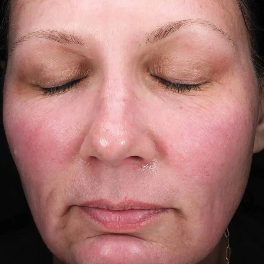 Front view of a woman before Moxi, showing high colour across both cheeks and the nose with a dull, uneven surface