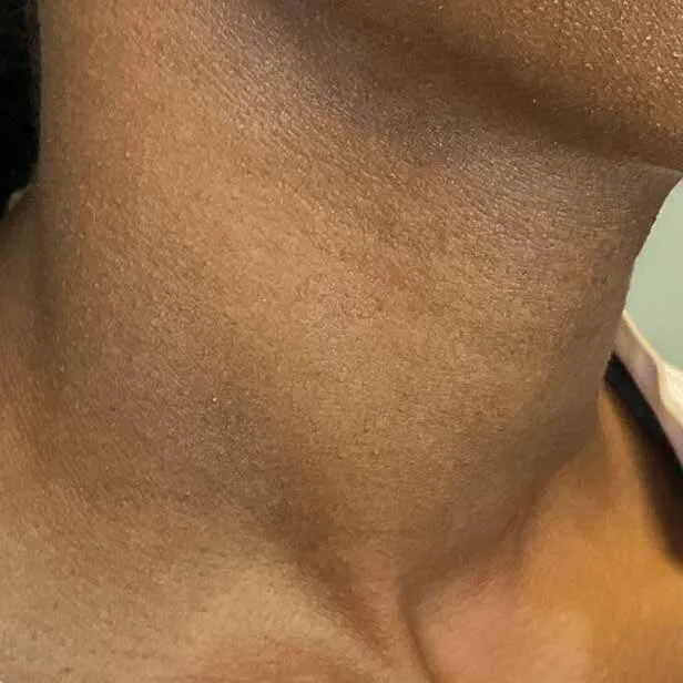 The same neck after Moxi, with the mottling resolved and the tone continuous