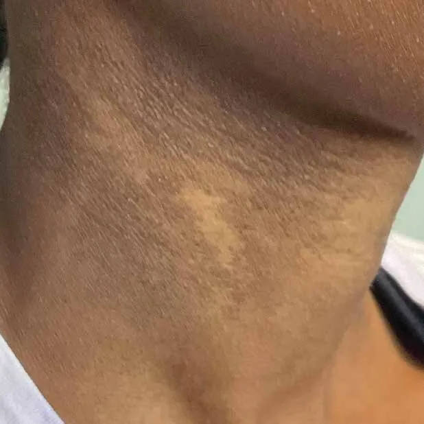 Side of a neck before Moxi, showing mottled sun damage in patches down towards the collarbone