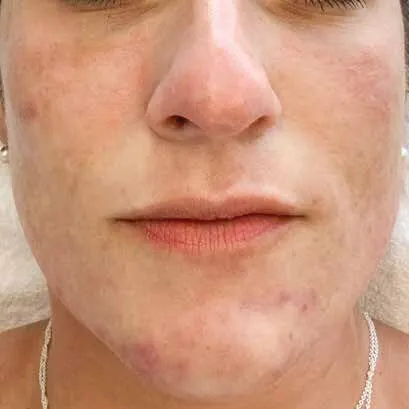 Lower face of a woman before Moxi, showing marks left across the cheek and jaw that hold the tone uneven