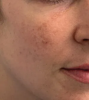 Close-up of a cheek before Moxi, showing brown pigment mottling the surface with dulled tone around it