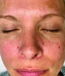 Front view of a woman before Moxi, showing sun spots scattered over the forehead and cheeks on a ruddy base