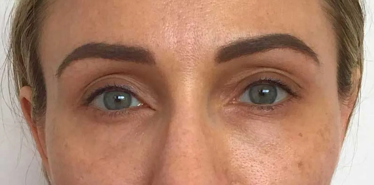 Non-Surgical Blepharoplasty: A Comprehensive Guide to Eyelid Rejuvenation Without Surgery