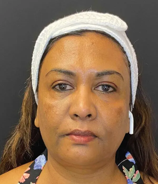 Front view of a woman before treatment, showing brown melasma patching set across both cheeks and carried up onto the forehead