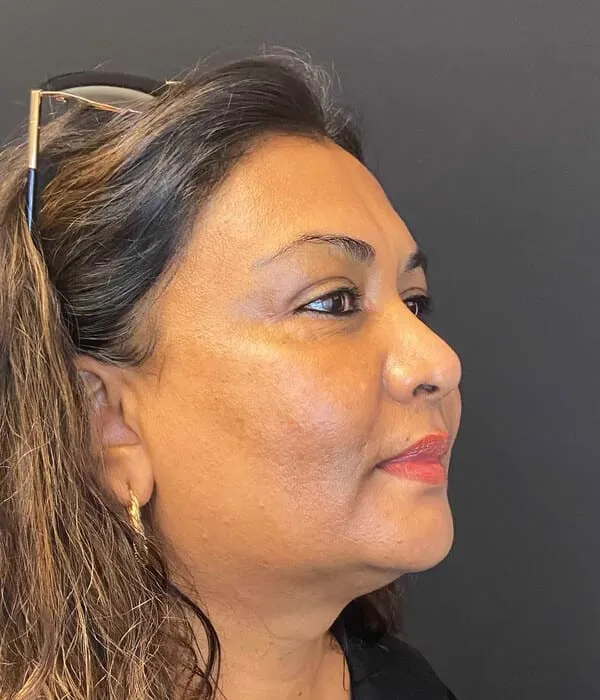 The same three-quarter view after treatment, with the patch over the cheekbone lighter and the surrounding tone more even