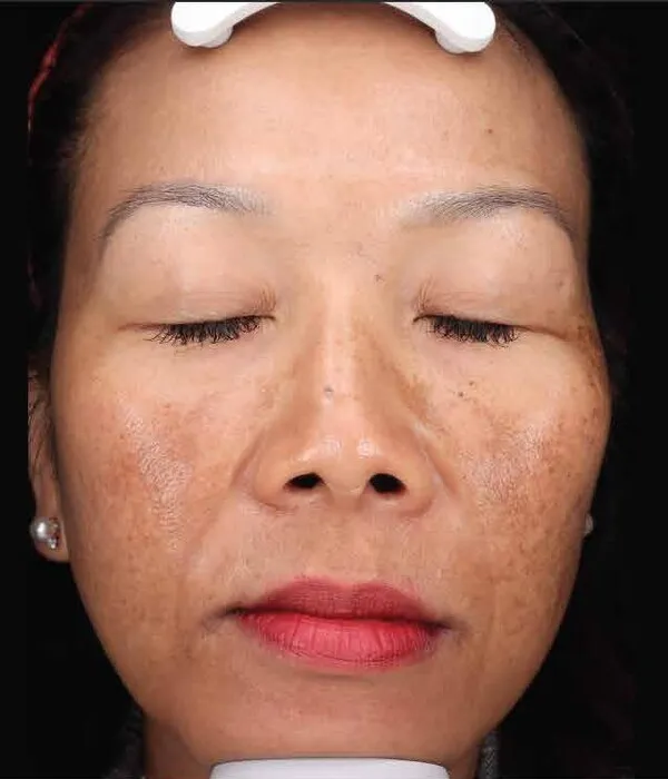 Front view of a second woman before treatment, showing dense brown pigment massed across both cheeks and over the bridge of the nose