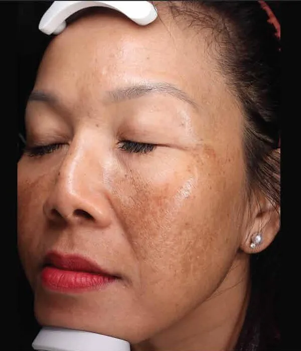 Three-quarter view of the same second woman before treatment, showing a heavy brown patch across the cheek and temple