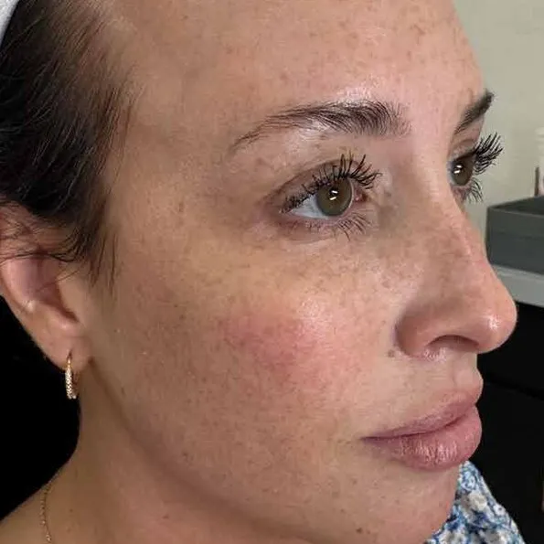 Three-quarter view of a woman before treatment, showing dense brown freckling scattered across the cheek and temple over a flushed base