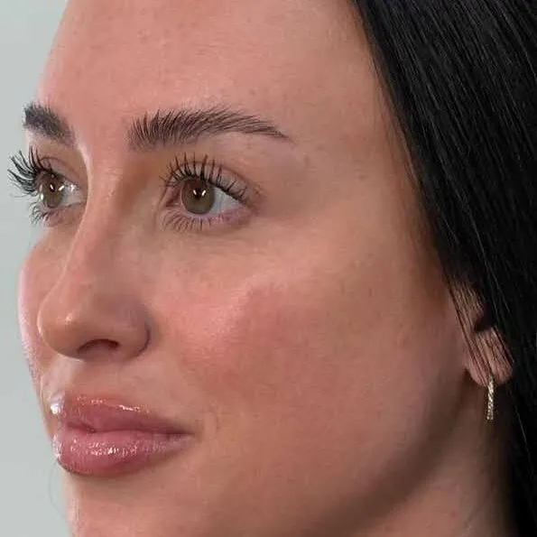 The same profile view after treatment, with the freckling across the cheek much reduced and the tone more settled