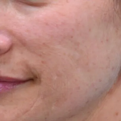The same cheek close-up after treatment, with the brown spots faded and the surface tone more even