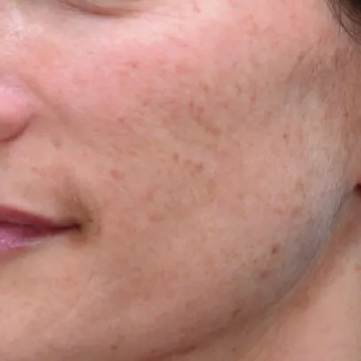 Close-up of a cheek before treatment, showing discrete brown sun spots scattered across the skin