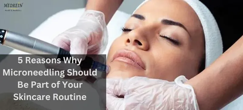 5 Reasons Why Microneedling Should Be Part of Your Skincare Routine