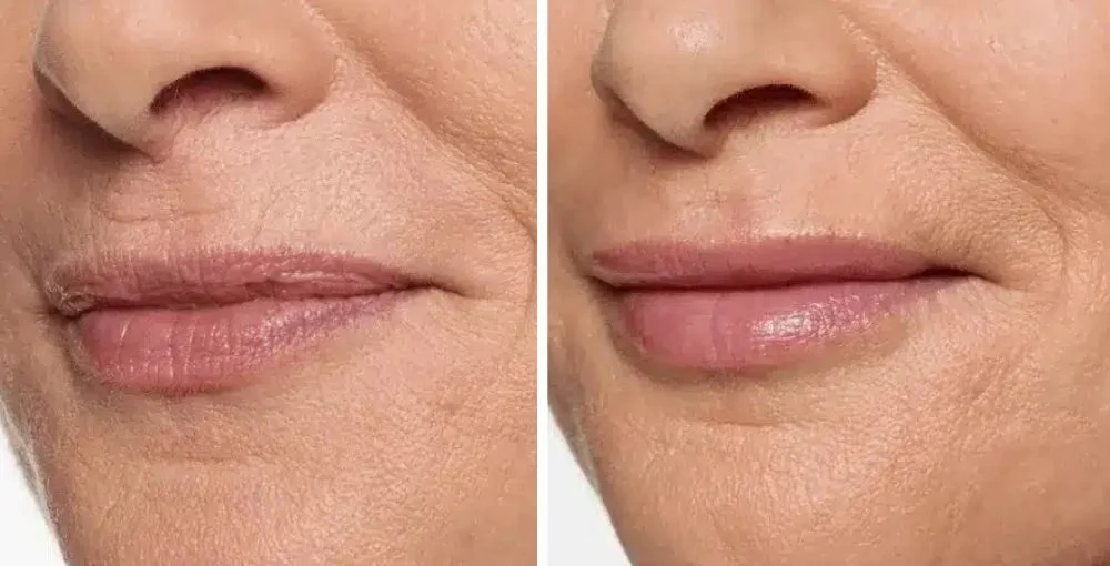 Restylane before and after, enlarged: the same person before treatment on the left and after treatment on the right, case 1. Results may vary.