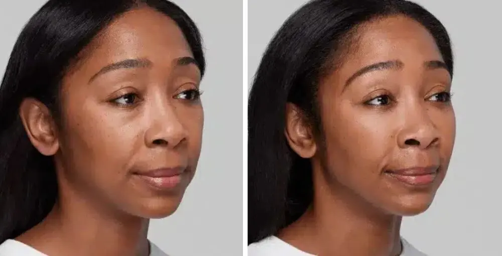 Restylane before and after: the same person before treatment on the left and after treatment on the right, case 2. Results may vary.