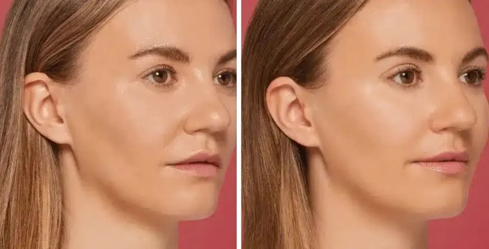 Restylane before and after: the same person before treatment on the left and after treatment on the right, case 3. Results may vary.
