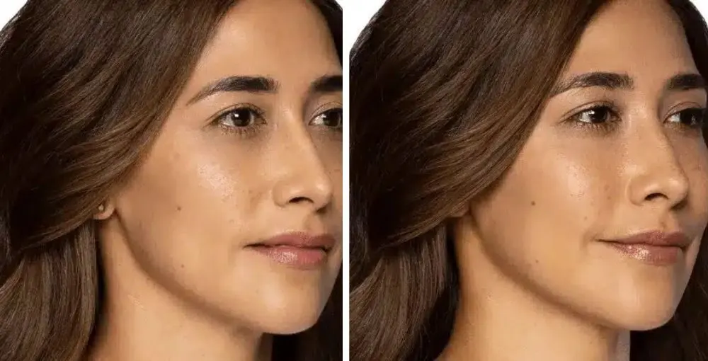 Restylane before and after: the same person before treatment on the left and after treatment on the right, case 4. Results may vary.