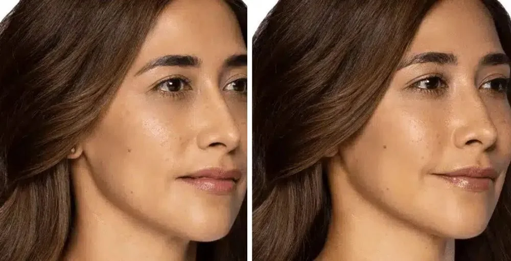 Restylane before and after, enlarged: the same person before treatment on the left and after treatment on the right, case 4. Results may vary.