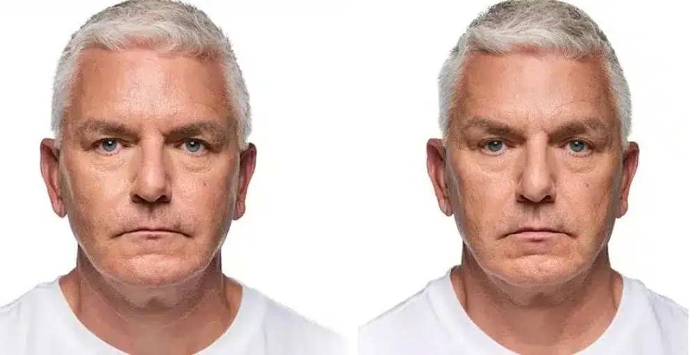 Revanesse (Versa) before and after: the same person before treatment on the left and after treatment on the right, case 1. Results may vary.