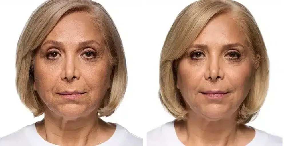 Revanesse (Versa) before and after: the same person before treatment on the left and after treatment on the right, case 2. Results may vary.