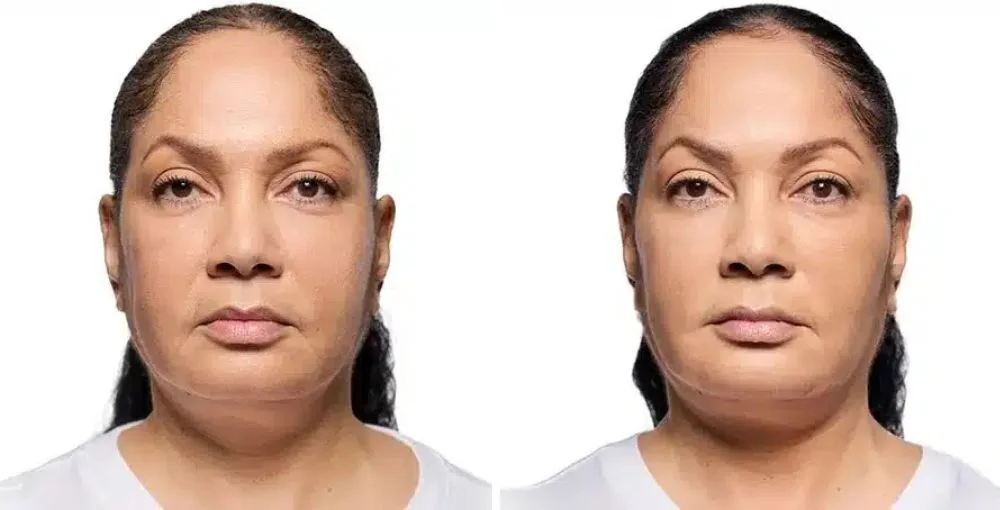 Revanesse (Versa) before and after, enlarged: the same person before treatment on the left and after treatment on the right, case 3. Results may vary.