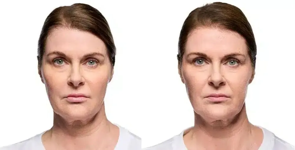 Revanesse (Versa) before and after: the same person before treatment on the left and after treatment on the right, case 4. Results may vary.