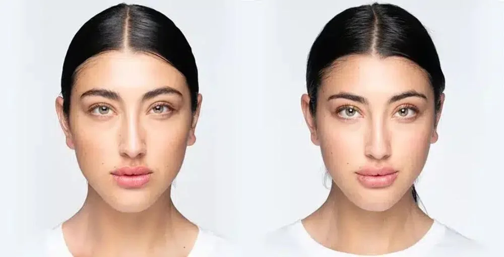 Revanesse (Versa) before and after, enlarged: the same person before treatment on the left and after treatment on the right, case 5. Results may vary.