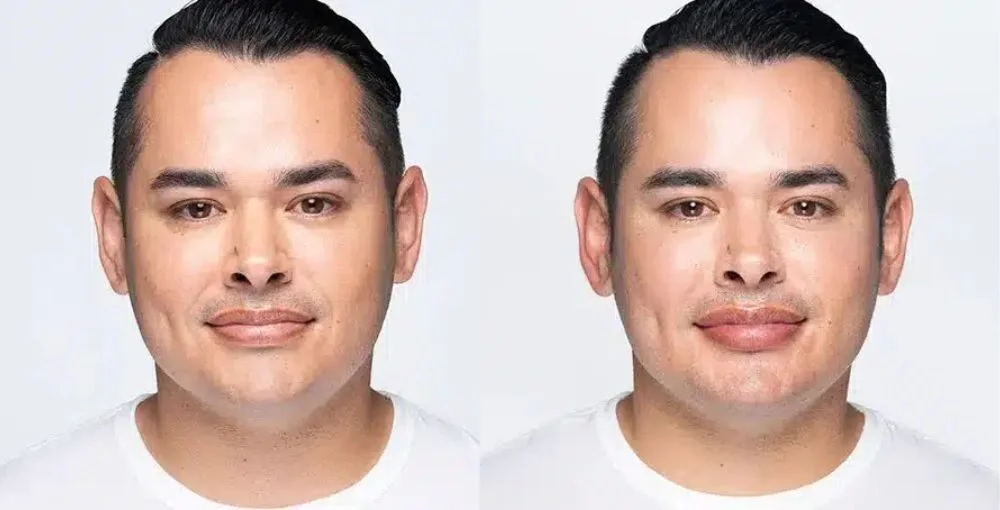 Revanesse (Versa) before and after, enlarged: the same person before treatment on the left and after treatment on the right, case 6. Results may vary.