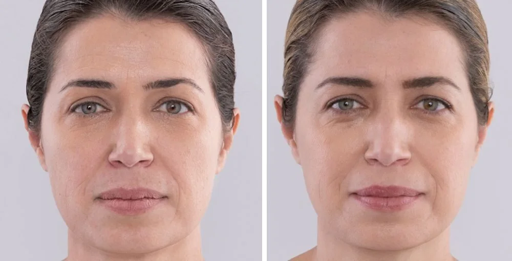Sculptra before and after, enlarged: the same person before treatment on the left and after treatment on the right, case 1. Results may vary.