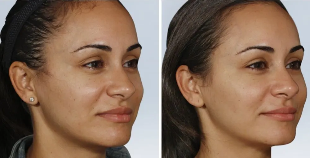 Sculptra before and after: the same person before treatment on the left and after treatment on the right, case 2. Results may vary.