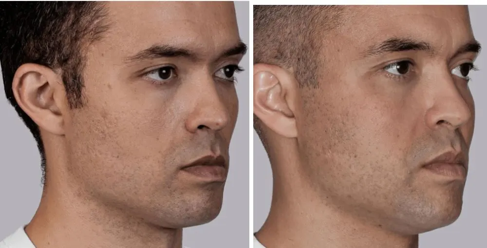 Sculptra before and after: the same person before treatment on the left and after treatment on the right, case 3. Results may vary.