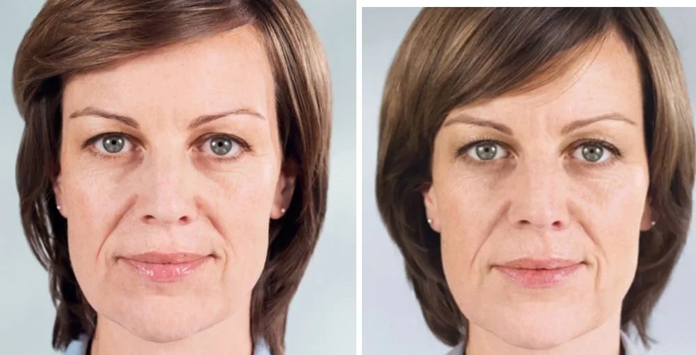 Sculptra before and after, enlarged: the same person before treatment on the left and after treatment on the right, case 4. Results may vary.