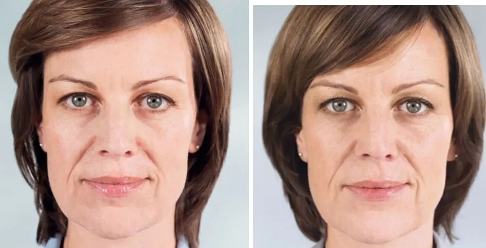 Sculptra before and after: the same person before treatment on the left and after treatment on the right, case 4. Results may vary.