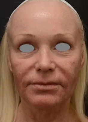 The same front view after laser resurfacing, with the tone more even and the lines around the mouth softened