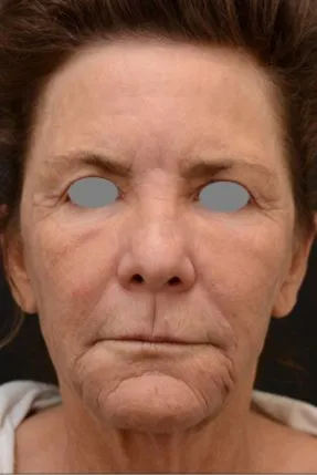 The same front view after laser resurfacing, with the folds softened and the surface noticeably smoother