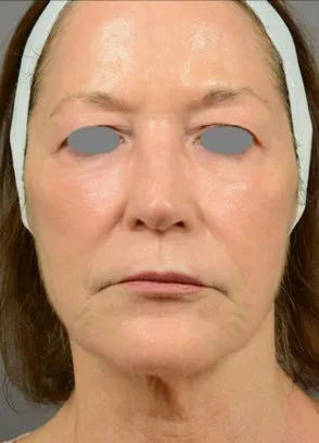 The same front view after laser resurfacing, with the lower face smoother and the neck tighter