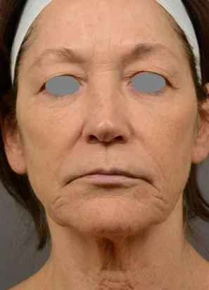 Front view of a woman before laser resurfacing, showing lines from the mouth to the jaw and banding across the neck