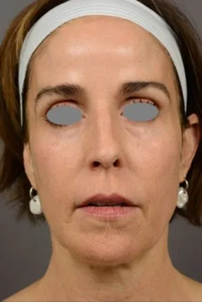 The same front view after laser resurfacing, with the lines lighter and the tone brighter and more even