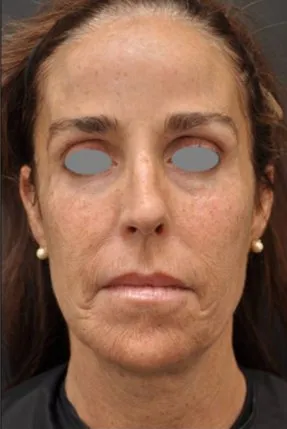 Front view of a woman before laser resurfacing, showing fine lines across the cheeks and dull, uneven tone
