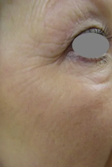 The same close-up after laser resurfacing, with the crepey lines much reduced