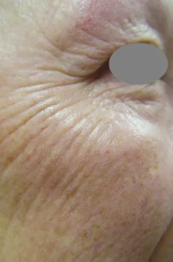 Close-up of the outer eye area before laser resurfacing, showing fine crepey lines fanning across the cheekbone