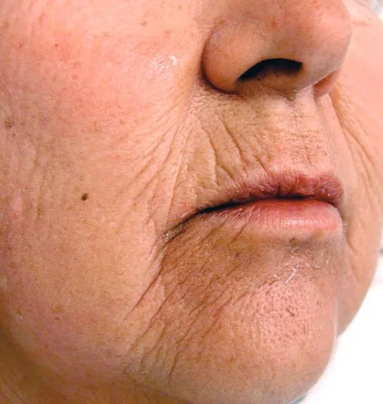 Close-up of the mouth and chin before laser resurfacing, showing vertical lines stacked around the lips and creasing over the chin