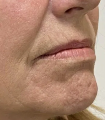 The same three-quarter view after laser resurfacing, with the pigment lifted and the chin texture evened
