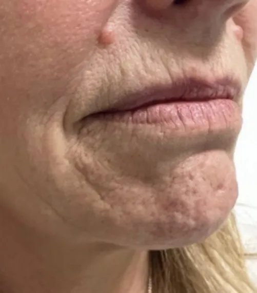 Three-quarter view of the lower face before laser resurfacing, showing lines around the mouth and mottled pigment over the chin