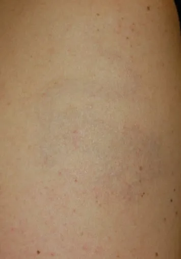 The same upper arm after laser tattoo removal, with the lizard cleared