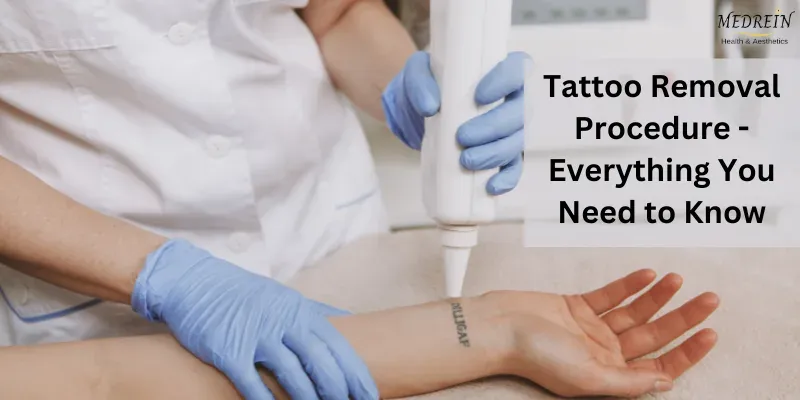 Tattoo Removal Procedure - Everything You Need to Know