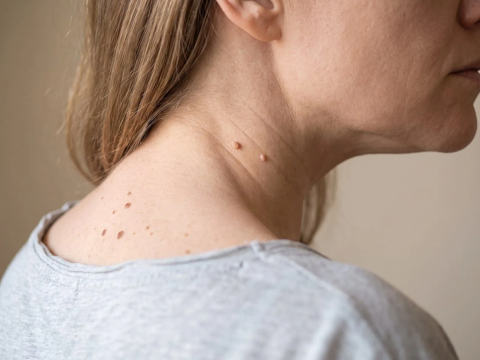 Close-up of a benign neck lesion suited to Fotona laser removal at Medrein Health
