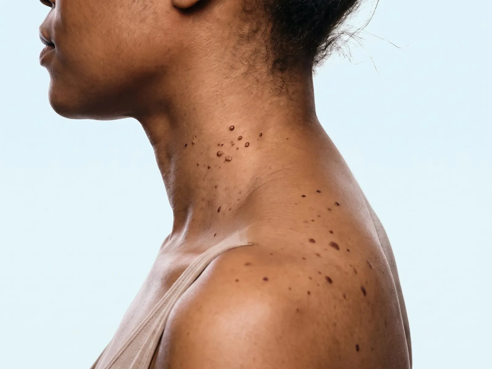 Small raised skin tags on the side of the neck and flat moles across the shoulder, the kind of benign growths this treatment removes
