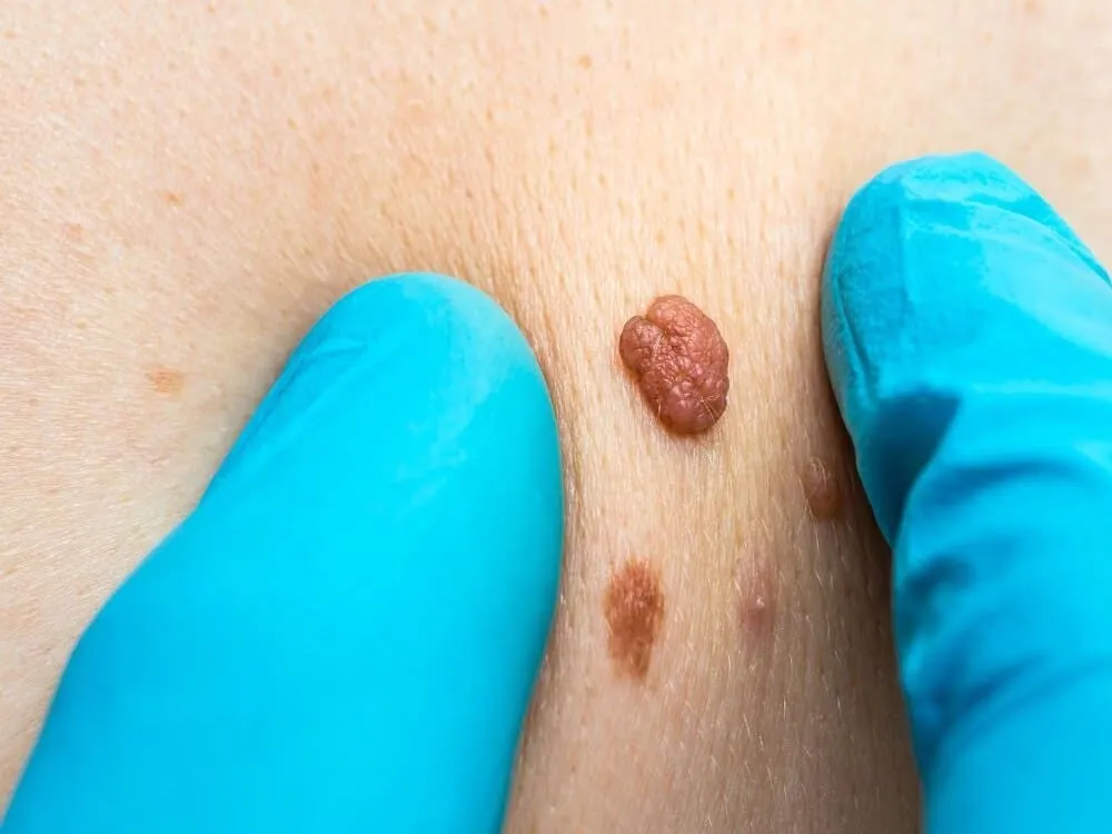 Gloved fingers holding the skin taut on either side of a benign skin tag and two small moles during an examination before laser removal